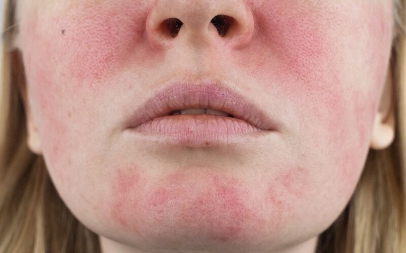 TRADZIK RÓŻOWATY. cera naczyniowa