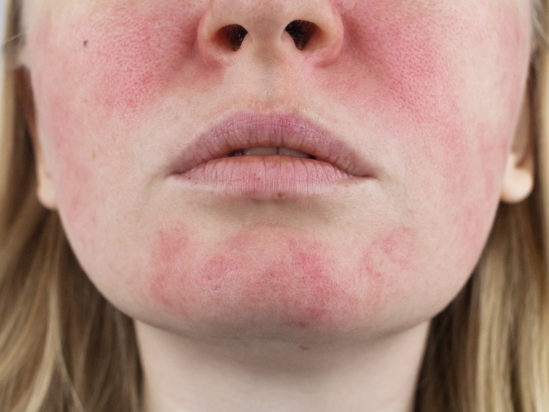 TRADZIK RÓŻOWATY. cera naczyniowa