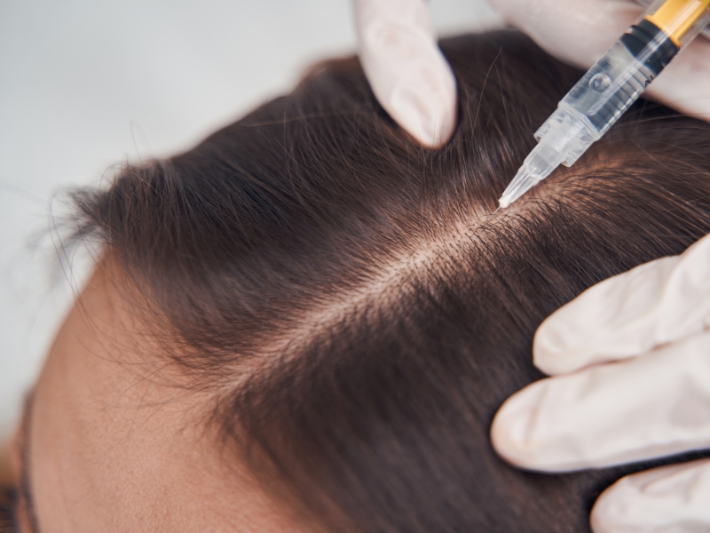 MEZOTERAPIA IGŁOWA NA SKÓRĘ GŁOWY