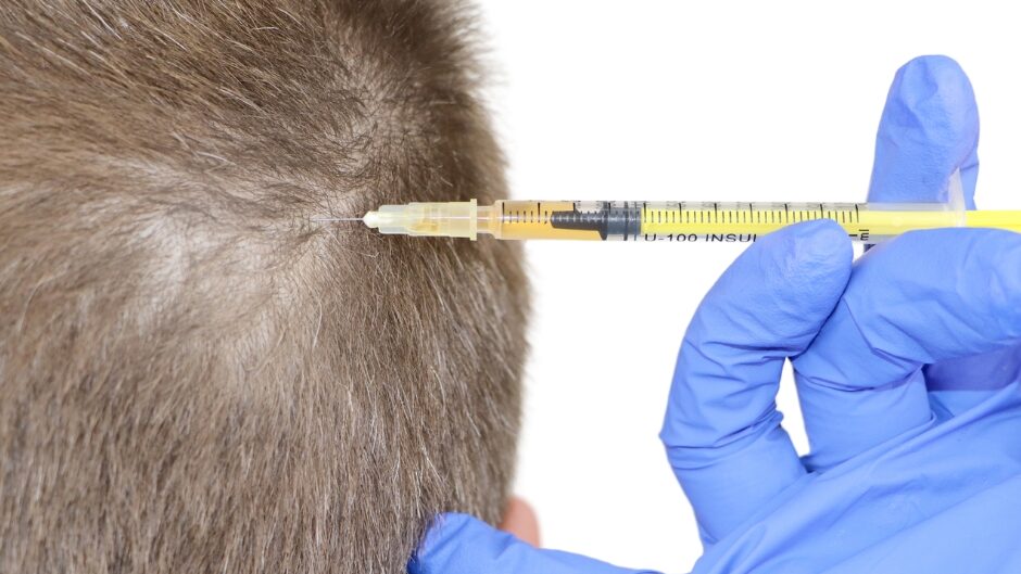 MEZOTERAPIA IGŁOWA NA SKÓRĘ GŁOWY